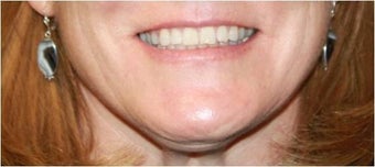 Lip augmentation - juvederm 435618