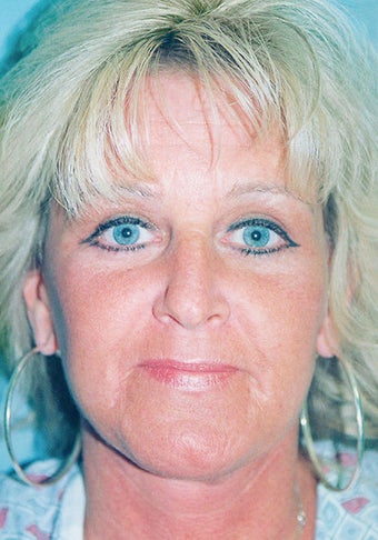 Lower Facelift & Neck Lift (w/ Liposuction) + Blepharoplasty after 280774