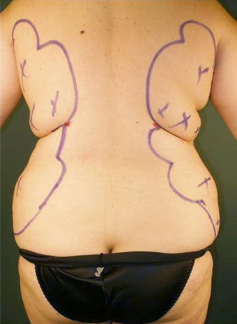 Pure Tumescent Liposuction before 552075