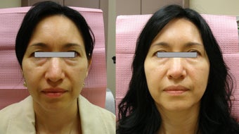 Botox Cosmetic before 363739