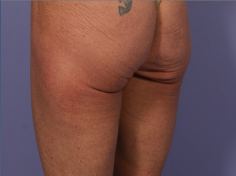CoolSculpting to Banana Roll/ Upper, Posterior thigh before 563835