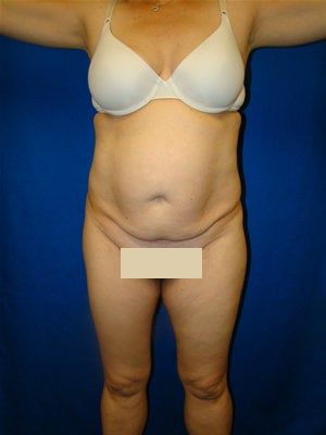 Extended Tummy Tuck Surgery before 151543