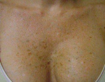 IPL - Intense Pulse Light before 414355