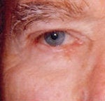 Eyelid skin cancer reconstruction after 84505