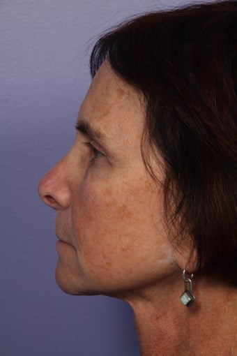 Neck lift after 306413