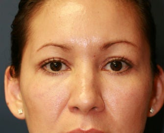 Upper and Lower Eyelid Blepharoplasty after 326448