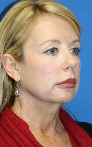 Facelift, Necklift, Fat Transfer, Upper Bleph., Lower Eyelid Skin Pinch before 392453