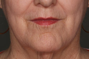 Juvederm Lip Enhancement before 610606