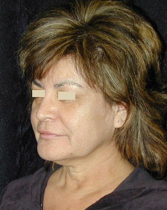 Facelift / Necklift before 103844