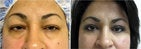Blepharoplasty before 512849