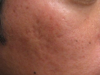 Artefill treatment of Acne Scars after 272001