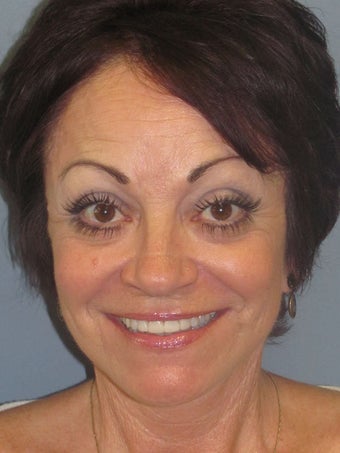 Lite Lift, Brow Lift 523289