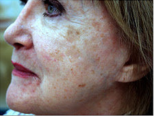 Fractional C02 laser before 533646