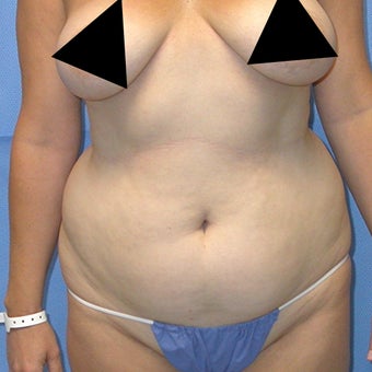 Liposuction of trunk. 648145