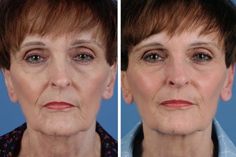 Juvederm Plus before 356494
