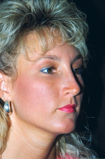 Rhinoplasty (nose job) after 235829