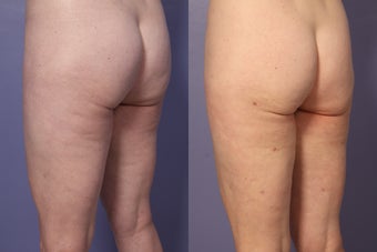 Cellulaze before 607916
