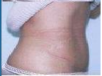 Abdominoplasty 67003