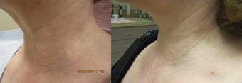 Intense pulsed light (IPL) before 363853