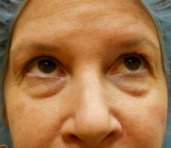 Under-Eye Filler Treatment before 567434