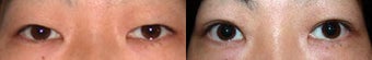 Asian Eyelid Surgery before 192147