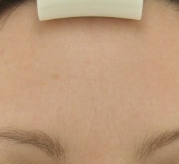 Forehead after Botox after 52830