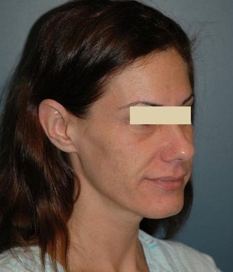 cheek lift before 137731