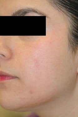 Facial Spider Vein Removal after 106532