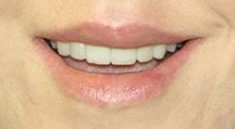 Lip Surgery, Lip Reduction after 458985