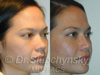 Asian Rhinoplasty after 624582