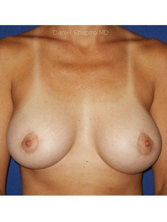 Bilateral periareolar mastopexy augmentation with placement of 421cc smooth silicone breast implants after 249998