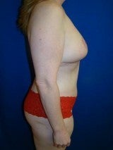 Breast Reduction, Mommy Makeover, Tummy Tuck (Abdominoplasty) 412073