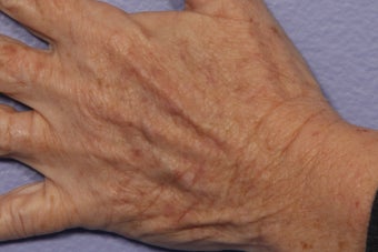 IPL Limelight to Hands after 309737