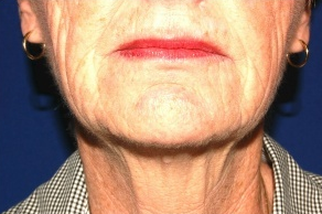 Facelift, Intense Pulsed Light before 132103