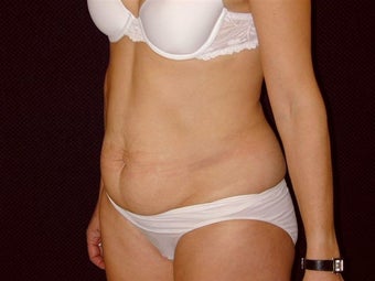 Tummy Tuck and Liposuction before 269291