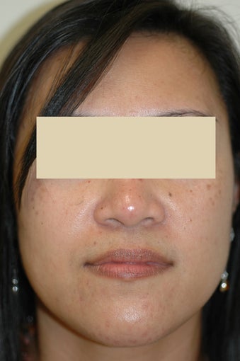Laser Acne Treatment after 87987