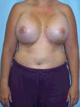 Revision Breast Surgery after 370397