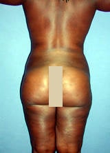 Body Contouring with Liposuction after 133788