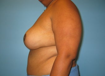 breast reduction after 284100
