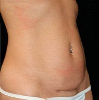Mini Tummy Tuck before 411082