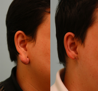 Keloid Removal before 138534