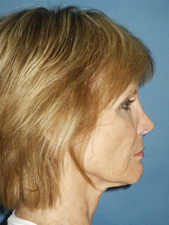 Facelift, Endoscopic Browlift, Upper and Lower Blepharoplasty, Perioral Dermabrasion before 248859