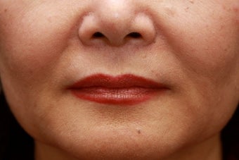 Fill the nasolabial folds and marionette lines after 508924