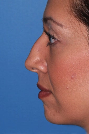 Rhinoplasty before 91601