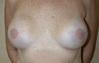 Breast Reconstruction after 526305