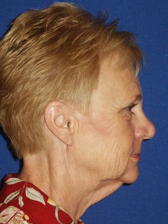 Facelift, Anterior Hairline Browlift, Upper and Lower Blepharoplasty with Canthopexy, Lip augmentation with Alloderm Grafts before 248892