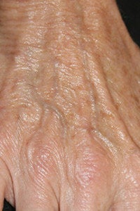 Radiesse hand injection before 255552