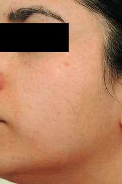 Facial Spider Vein Removal before 106532