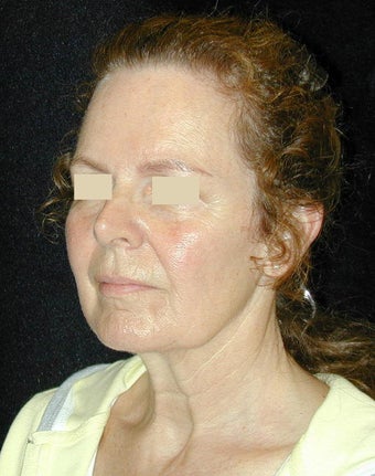 Facelift / Necklift before 103851