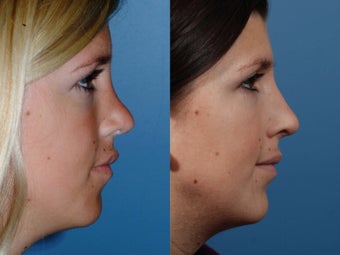 Revision rhinoplasty after 436945